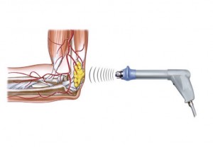 dispersion-del-mediador-del-dolor-sustancia-p